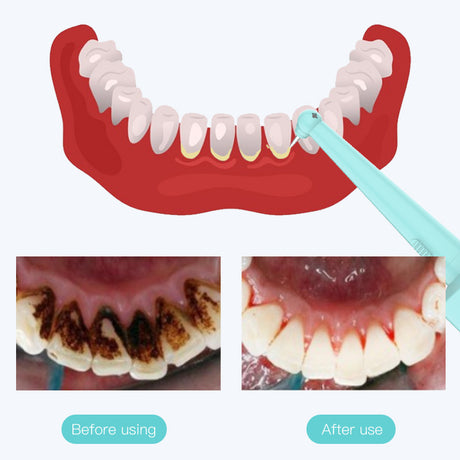 Intelligent High-Frequency Vibration Dental Calculus & Stain Remover(black)