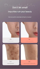 Professional Electric Mole & Dark Spot Remover Pen - Advanced Plasma Ion Technology for Seamless Skin Tag & Freckle Removal (Purple)