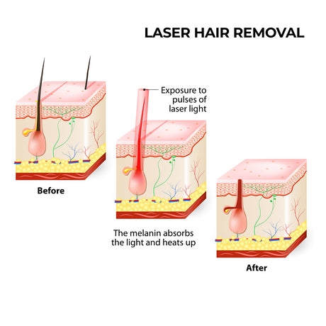 Silhouette Portable Laser Hair Remover Permanent Epliation System Body Face Home